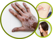 Vitiligo Skin Disorder